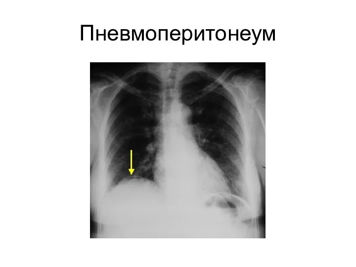 Пневмоперитонеум