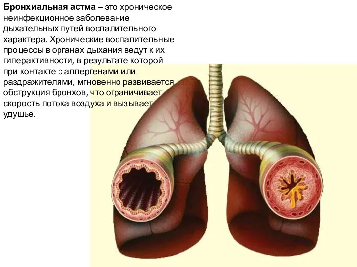 Бронхиальная астма – это хроническое неинфекционное заболевание дыхательных путей воспалительного характера. Хронические