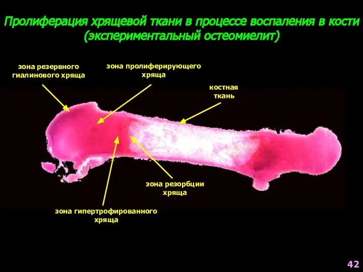 Пролиферация хрящевой ткани в процессе воспаления в кости (экспериментальный остеомиелит) зона резервного