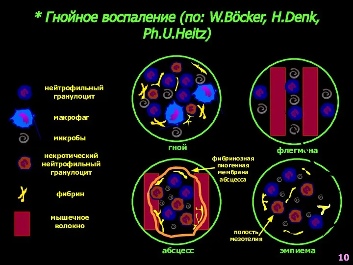 * Гнойное воспаление (по: W.Böcker, H.Denk, Ph.U.Heitz) нейтрофильный гранулоцит макрофаг микробы некротический