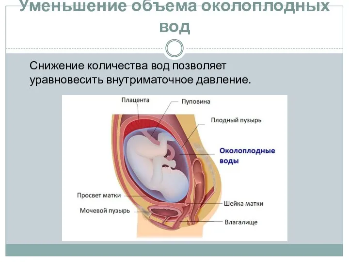 Уменьшение объема околоплодных вод Снижение количества вод позволяет уравновесить внутриматочное давление.