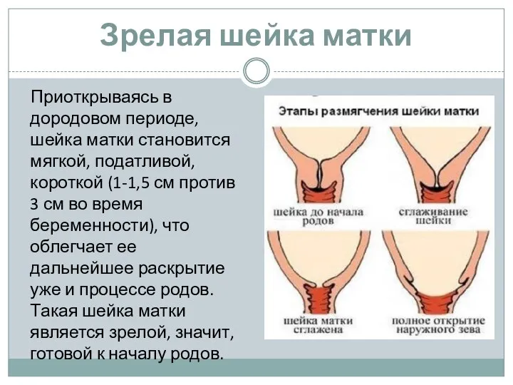 Зрелая шейка матки Приоткрываясь в дородовом периоде, шейка матки становится мягкой, податливой,