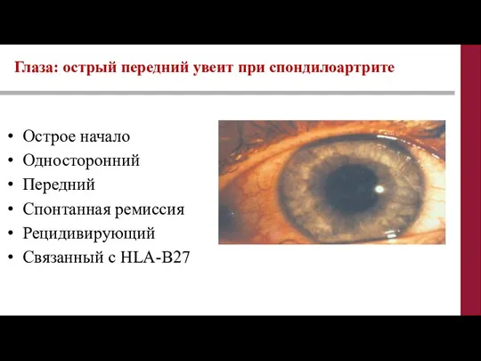 Глаза: острый передний увеит при спондилоартрите Острое начало Односторонний Передний Спонтанная ремиссия Рецидивирующий Связанный с HLA-B27