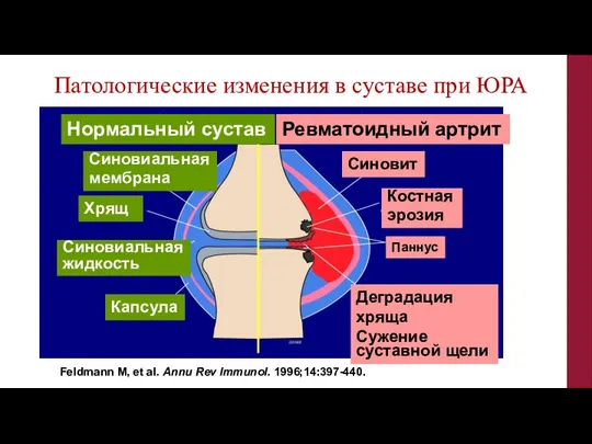 Патологические изменения в суставе при ЮРА Feldmann M, et al. Annu Rev