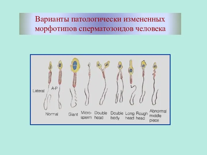 Варианты патологически измененных морфотипов сперматозоидов человека