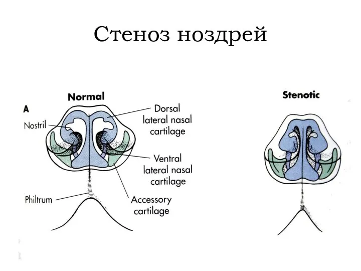 Стеноз ноздрей