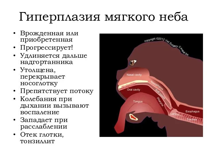 Гиперплазия мягкого неба Врожденная или приобретенная Прогрессирует! Удлиняется дальше надгортанника Утолщена, перекрывает