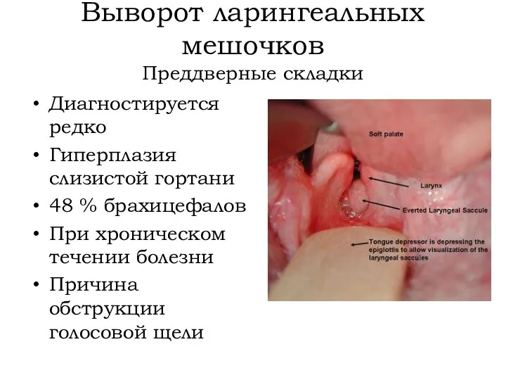 Выворот ларингеальных мешочков Преддверные складки Диагностируется редко Гиперплазия слизистой гортани 48 %