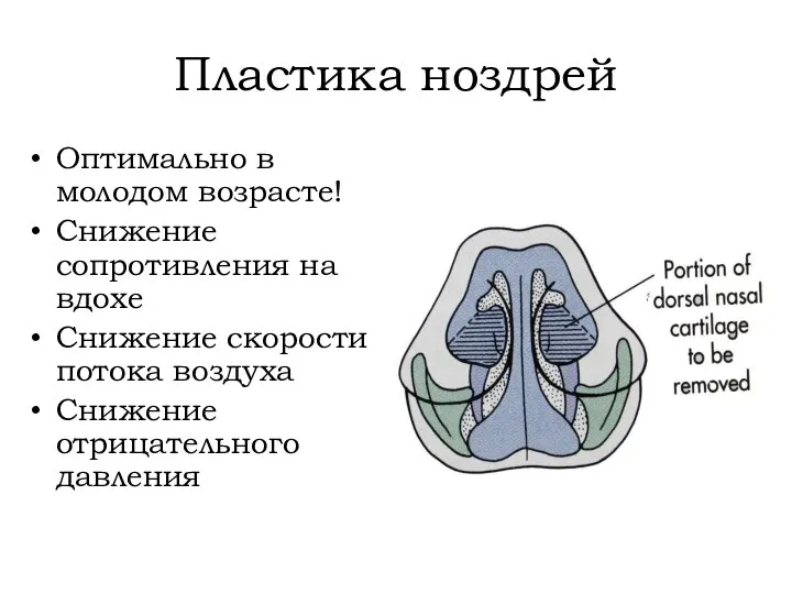 Пластика ноздрей Оптимально в молодом возрасте! Снижение сопротивления на вдохе Снижение скорости