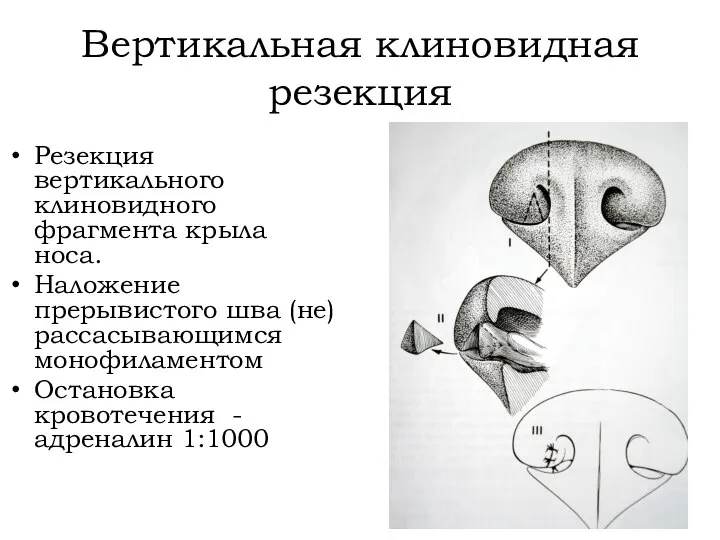 Вертикальная клиновидная резекция Резекция вертикального клиновидного фрагмента крыла носа. Наложение прерывистого шва