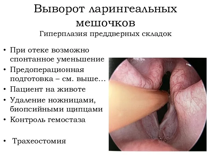 Выворот ларингеальных мешочков Гиперплазия преддверных складок При отеке возможно спонтанное уменьшение Предоперационная