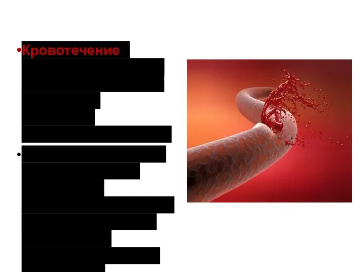 Кровотечение – излияние (вытекание) крови из кровеносных сосудов при нарушении целостности их