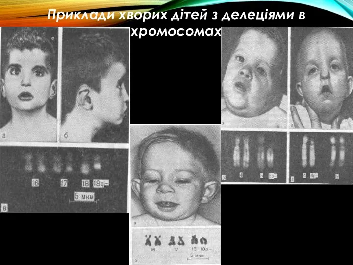 Приклади хворих дітей з делеціями в хромосомах