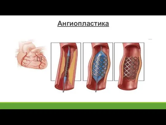 Ангиопластика