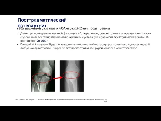 1. Е.А. Трофимов, В.И. Мазуров, Е.С. Мельников. Комбинированная медикаментозная терапия посттравматического гонартроза.