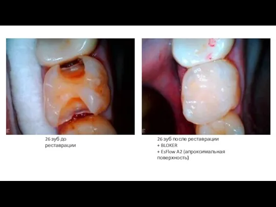26 зуб до реставрации 26 зуб после реставрации + BLOKER + EsFlow A2 (апроксимальная поверхность)
