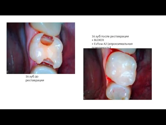 16 зуб после реставрации + BLOKER + EsFlow A2 (апроксимальная поверхность) 16 зуб до реставрации