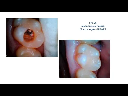 17 зуб воссстановление После эндо + BLOKER