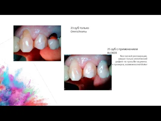 23 зуб только Omnichroma 25 зуб с применением BLOKER без полной реставрации,