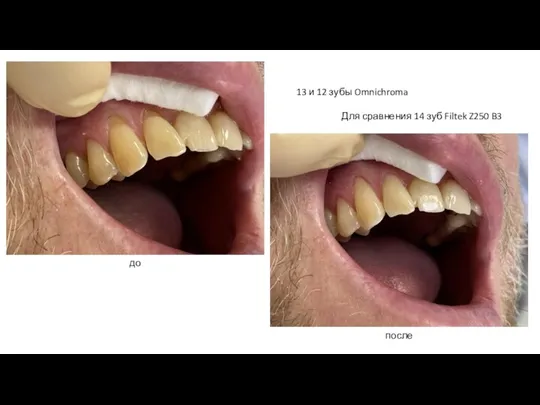 13 и 12 зубы Omnichroma Для сравнения 14 зуб Filtek Z250 B3 до после