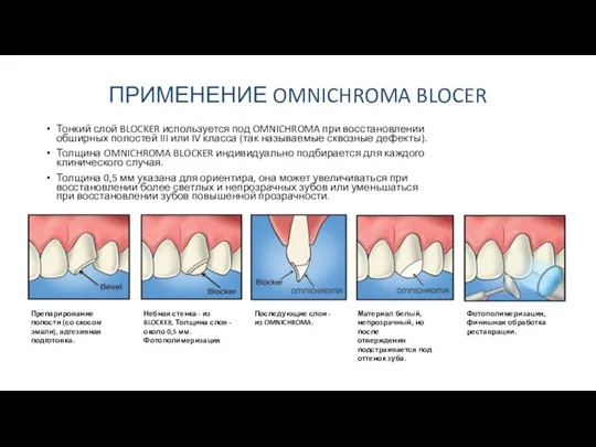 ПРИМЕНЕНИЕ OMNICHROMA BLOCER Тонкий слой BLOCKER используется под OMNICHROMA при восстановлении обширных