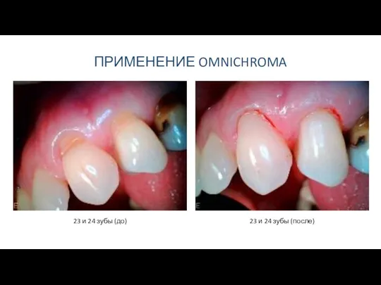 ПРИМЕНЕНИЕ OMNICHROMA 23 и 24 зубы (до) 23 и 24 зубы (после)