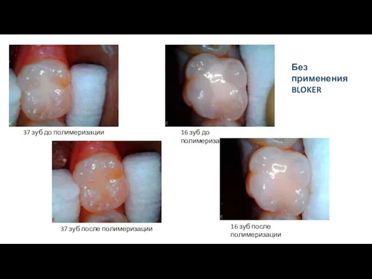 37 зуб до полимеризации 37 зуб после полимеризации 16 зуб до полимеризации