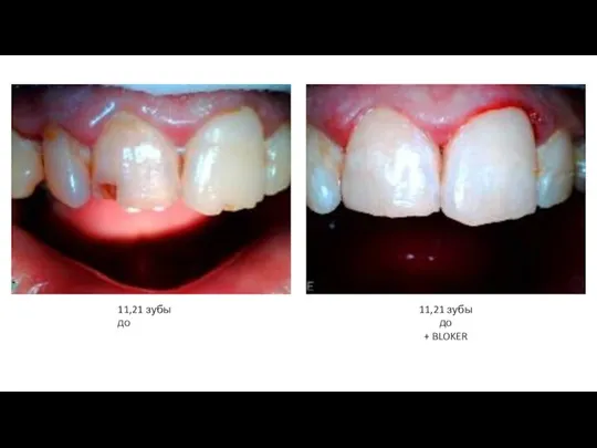 11,21 зубы до 11,21 зубы до + BLOKER
