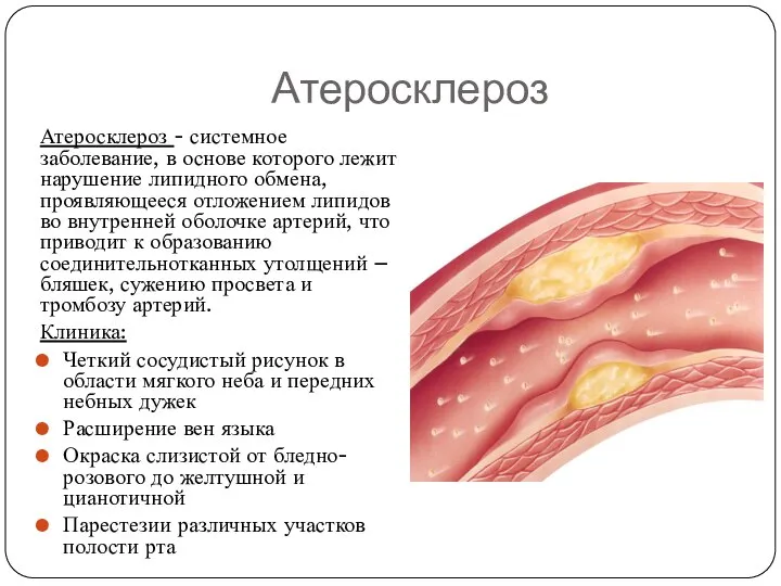 Атеросклероз Атеросклероз - системное заболевание, в основе которого лежит нарушение липидного обмена,