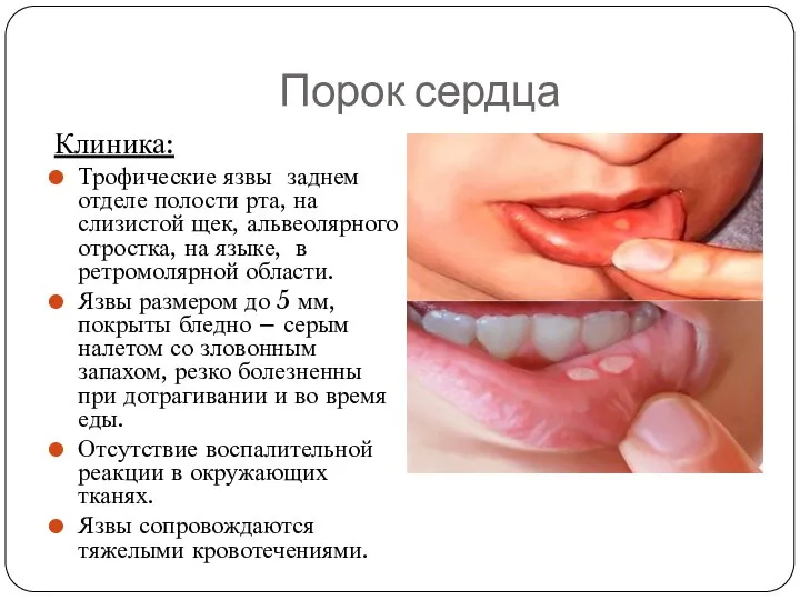 Порок сердца Клиника: Трофические язвы заднем отделе полости рта, на слизистой щек,