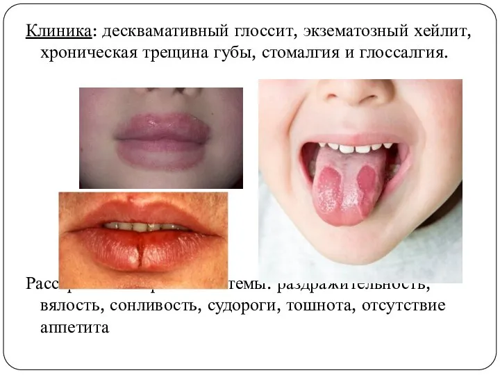 Клиника: десквамативный глоссит, экзематозный хейлит, хроническая трещина губы, стомалгия и глоссалгия. Расстройства