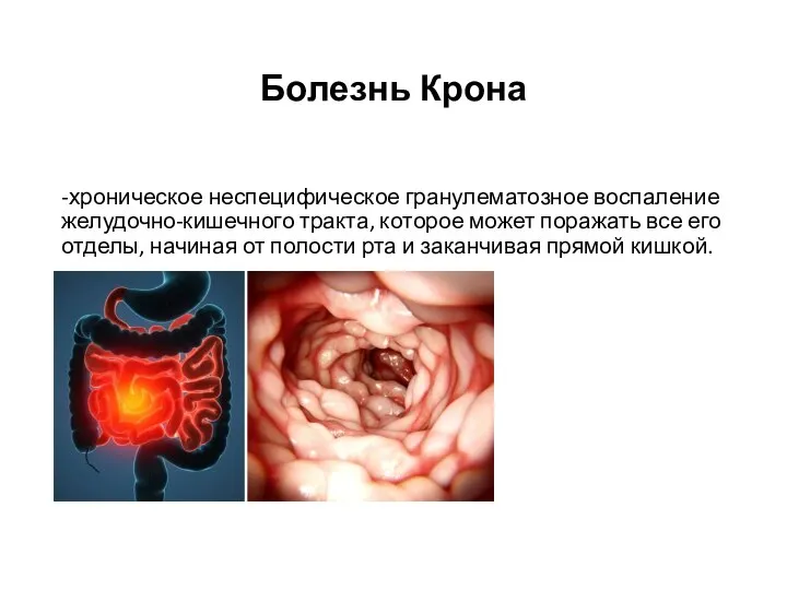 Болезнь Крона -хроническое неспецифическое гранулематозное воспаление желудочно-кишечного тракта, которое может поражать все