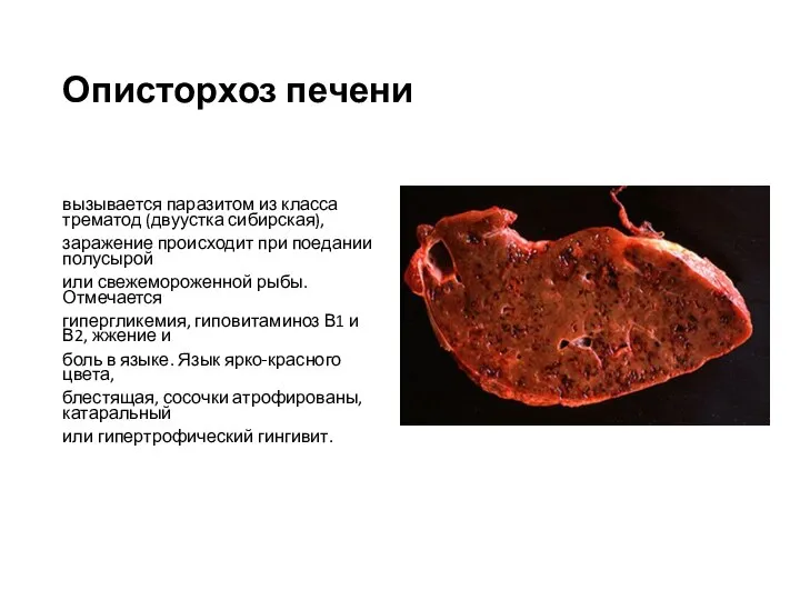 Описторхоз печени вызывается паразитом из класса трематод (двуустка сибирская), заражение происходит при