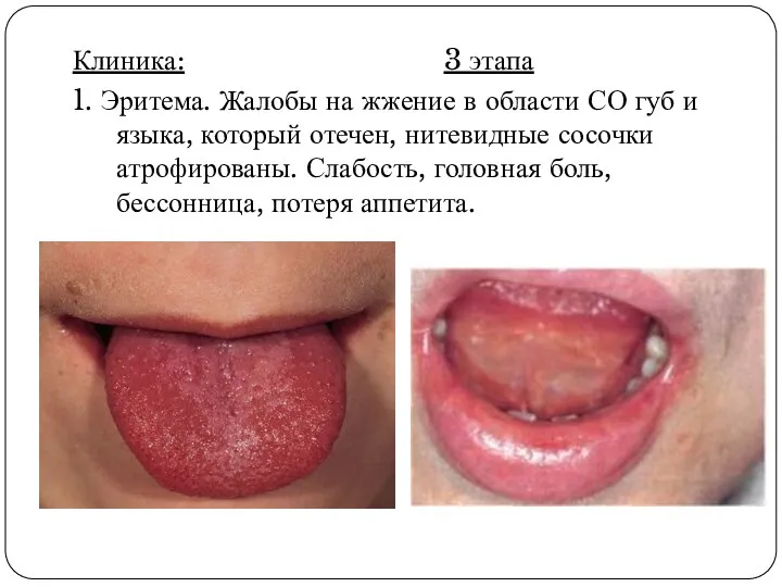 Клиника: 3 этапа 1. Эритема. Жалобы на жжение в области СО губ