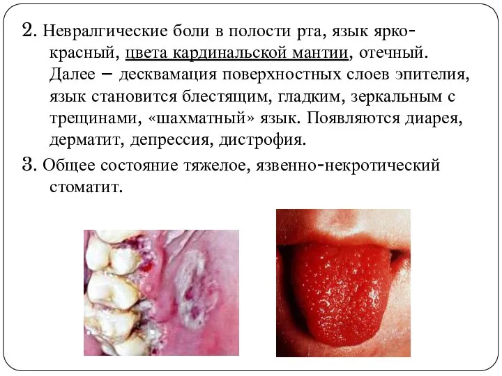 2. Невралгические боли в полости рта, язык ярко-красный, цвета кардинальской мантии, отечный.