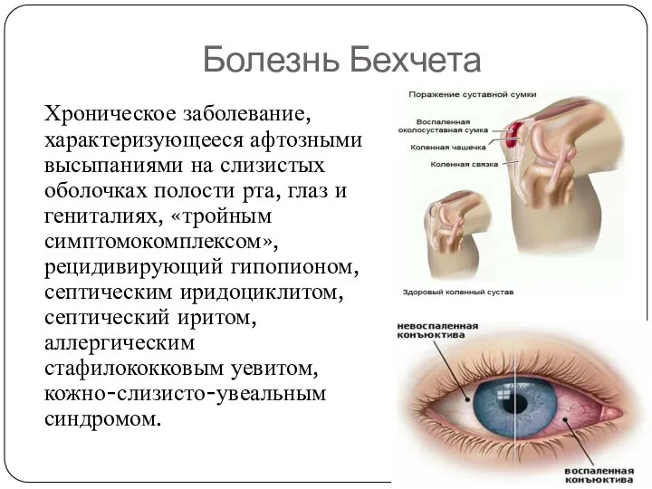 Болезнь Бехчета Хроническое заболевание, характеризующееся афтозными высыпаниями на слизистых оболочках полости рта,