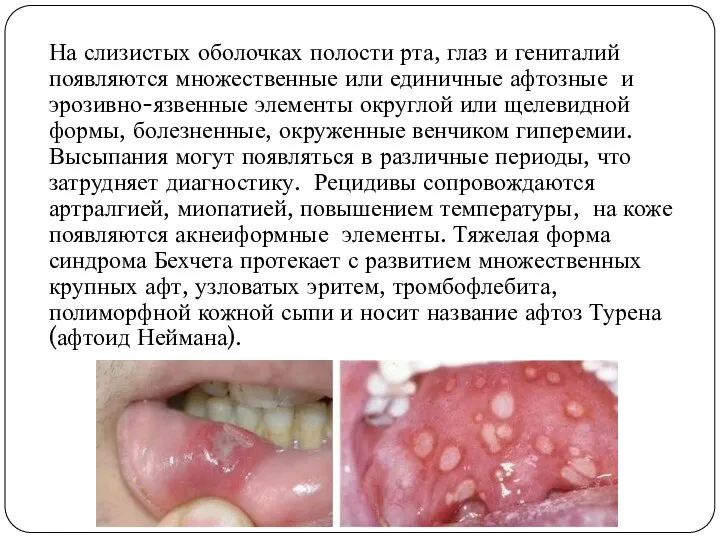 На слизистых оболочках полости рта, глаз и гениталий появляются множественные или единичные