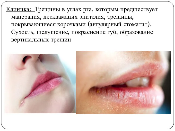 Клиника: Трещины в углах рта, которым предшествует мацерация, десквамация эпителия, трещины, покрывающиеся
