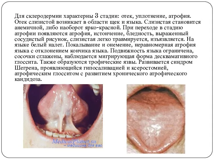 Для склеродермии характерны 3 стадии: отек, уплотнение, атрофия. Отек слизистой возникает в