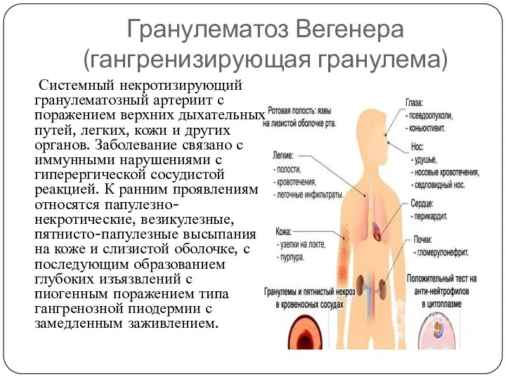 Гранулематоз Вегенера (гангренизирующая гранулема) Системный некротизирующий гранулематозный артериит с поражением верхних дыхательных