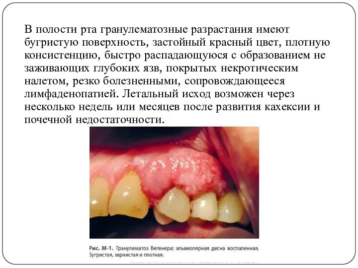 В полости рта гранулематозные разрастания имеют бугристую поверхность, застойный красный цвет, плотную