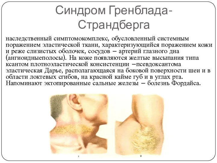 Синдром Гренблада-Страндберга наследственный симптомокомплекс, обусловленный системным поражением эластической ткани, характеризующийся поражением кожи