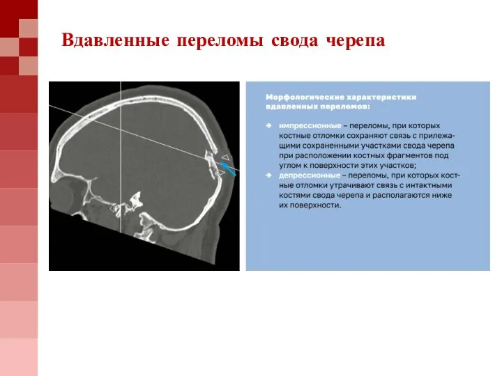 Вдавленные переломы свода черепа