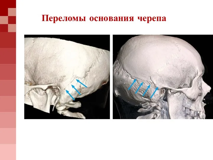 Переломы основания черепа