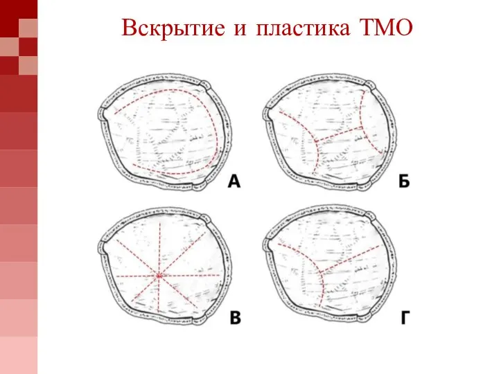 Вскрытие и пластика ТМО