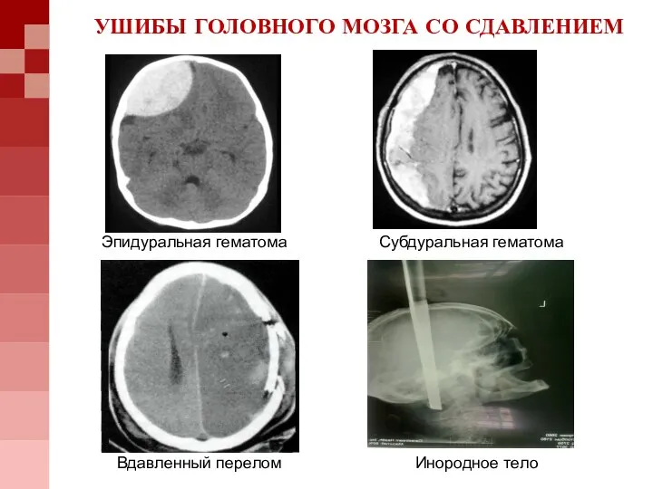 УШИБЫ ГОЛОВНОГО МОЗГА СО СДАВЛЕНИЕМ Эпидуральная гематома Субдуральная гематома Вдавленный перелом Инородное тело