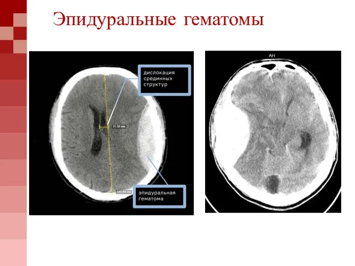 Эпидуральные гематомы