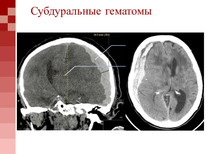 Субдуральные гематомы