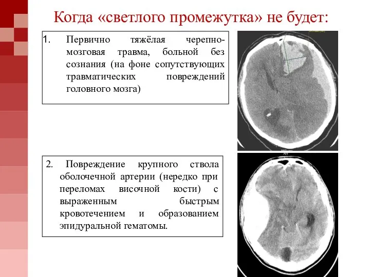 Когда «светлого промежутка» не будет: Первично тяжёлая черепно-мозговая травма, больной без сознания