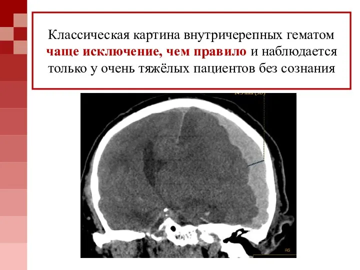 Классическая картина внутричерепных гематом чаще исключение, чем правило и наблюдается только у